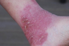 1_9-last-remaining-lesion