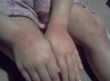 1_jocelyn-hand-3-month-_2015-04-21-08-41-32